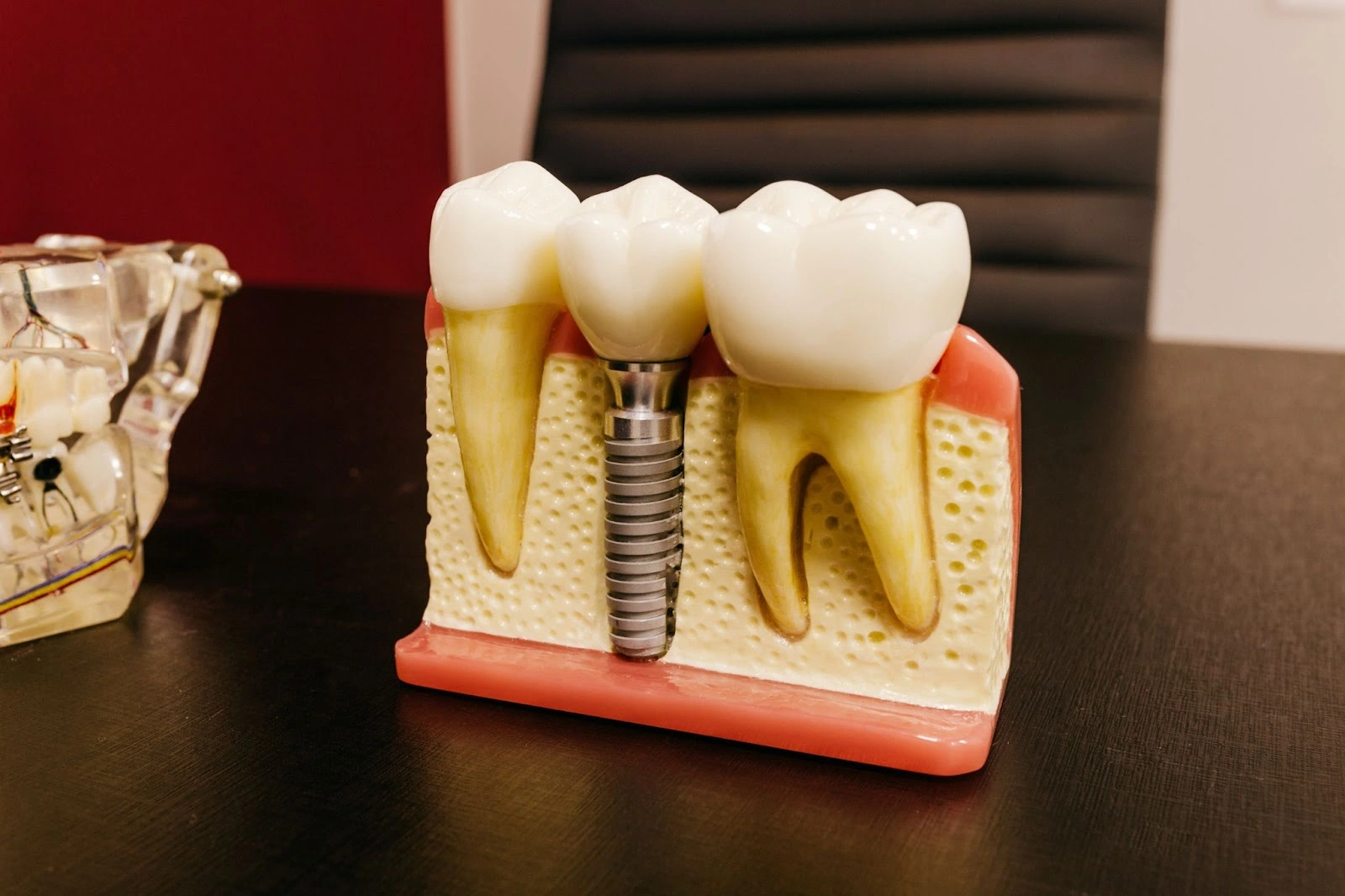 Model showing the process for dental implants, available at bayshore family dental in Dunedin, Florida